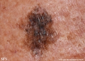 melanoma