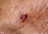 melanoma