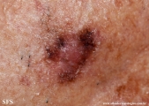 melanoma