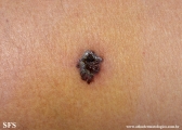 melanoma