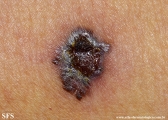 melanoma