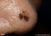 melanoma