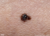 melanoma