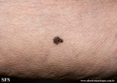 melanoma