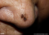 melanoma