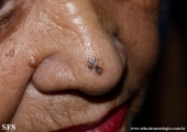melanoma