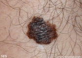 melanoma