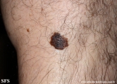 melanoma