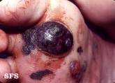melanoma