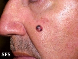melanoma