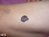 melanoma