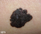 melanoma