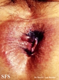 melanoma