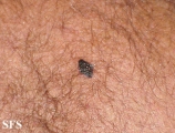 melanoma