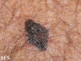 melanoma