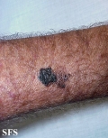 melanoma