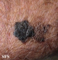 melanoma