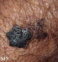 melanoma