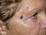 melanoma
