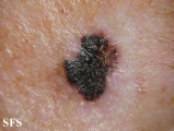 melanoma
