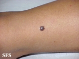 melanoma