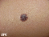 melanoma