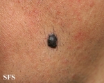 melanoma