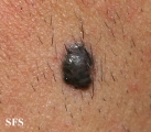 melanoma