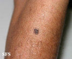 melanoma