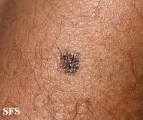 melanoma