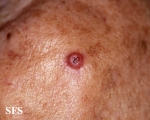 melanoma