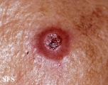 melanoma