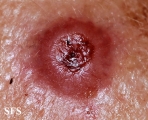 melanoma