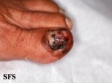 melanoma