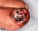 melanoma