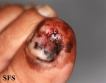 melanoma