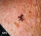 melanoma