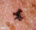 melanoma