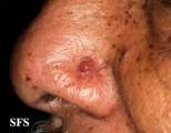 melanoma