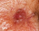 melanoma