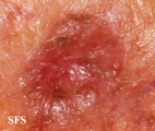melanoma