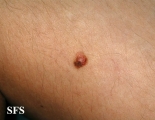 melanoma