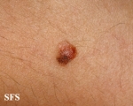 melanoma