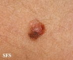 melanoma