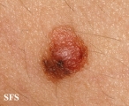melanoma