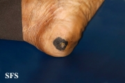melanoma