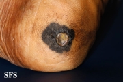 melanoma