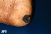 melanoma