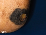 melanoma