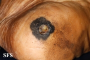 melanoma
